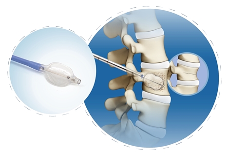 【脊柱】椎體擴張球囊導管(PKP)